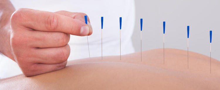 Madrid Chiropractor | Madrid chiropractic Acupuncture/Dry Needling | IA |